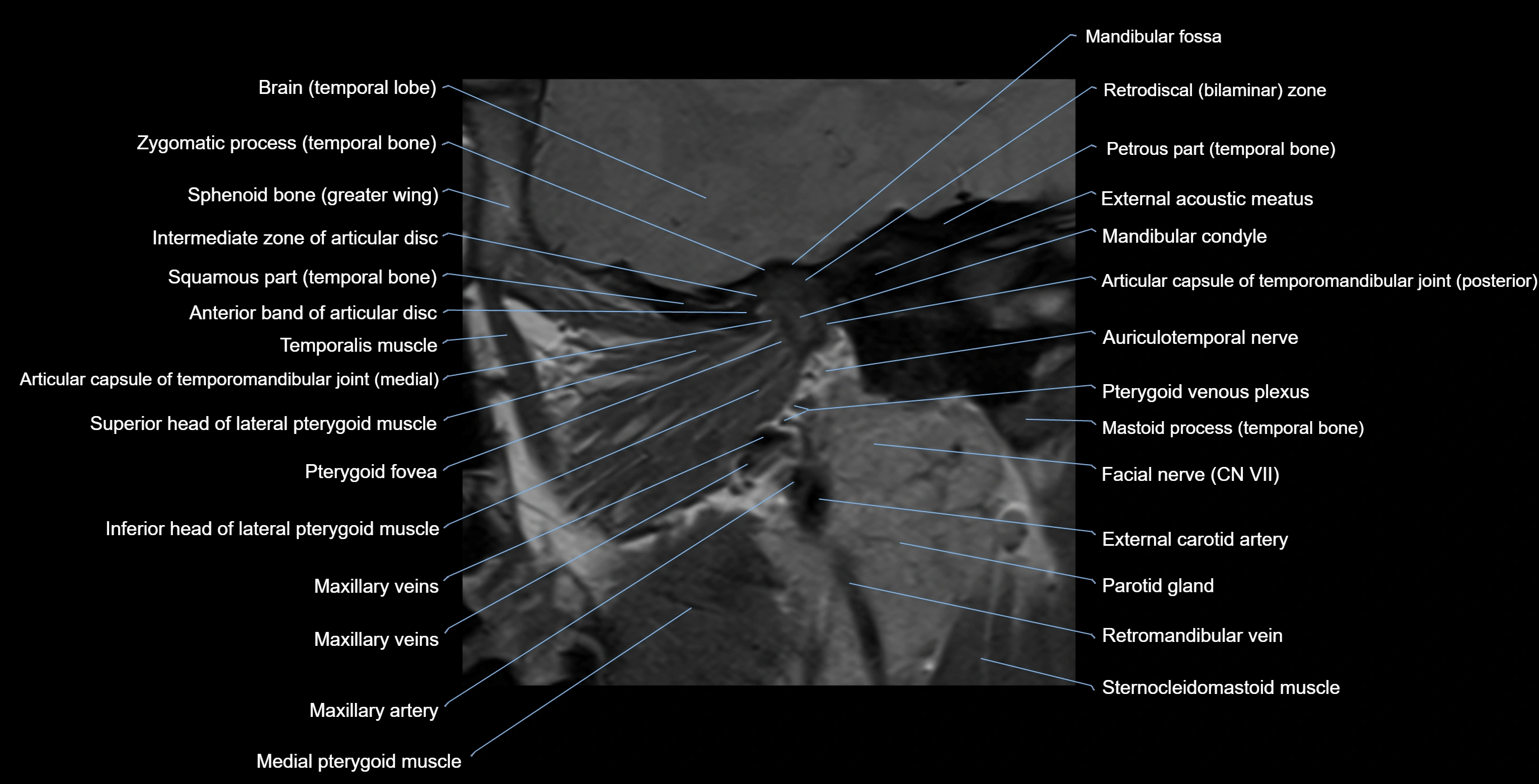 MRI TMJ sagittalclosed  mouth cross sectional 3T anatomy -img-00001-00011.webp
